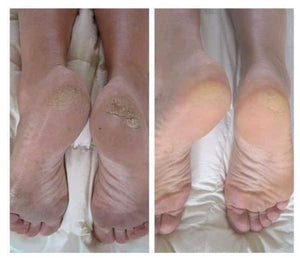 Sole solution cracked feet Lotion