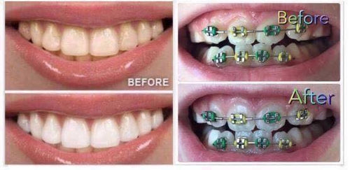 Whitening Toothpaste